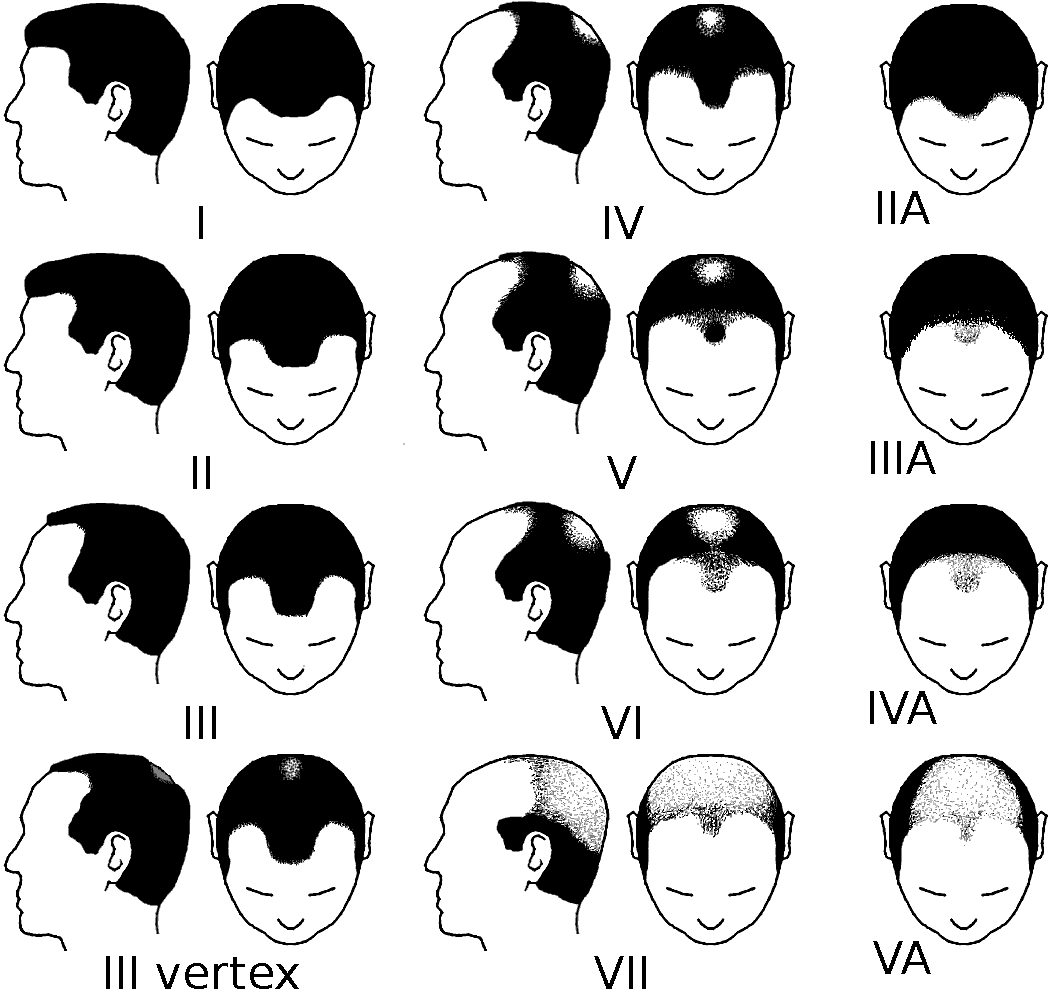 Finasteride Stop Hair Loss?